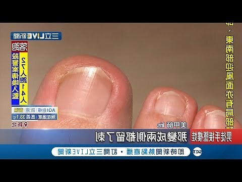 腳指甲 直紋